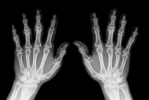 “Telescoping Fingers” Caused A Woman’s fingers To Shrink