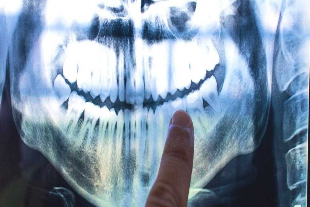 Eerie ‘Tree Ring’ Lines in Our Teeth Could Symbolize Life Events