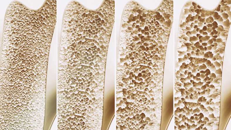 Osteoporosis Vs Osteopenia -Let’s know the difference